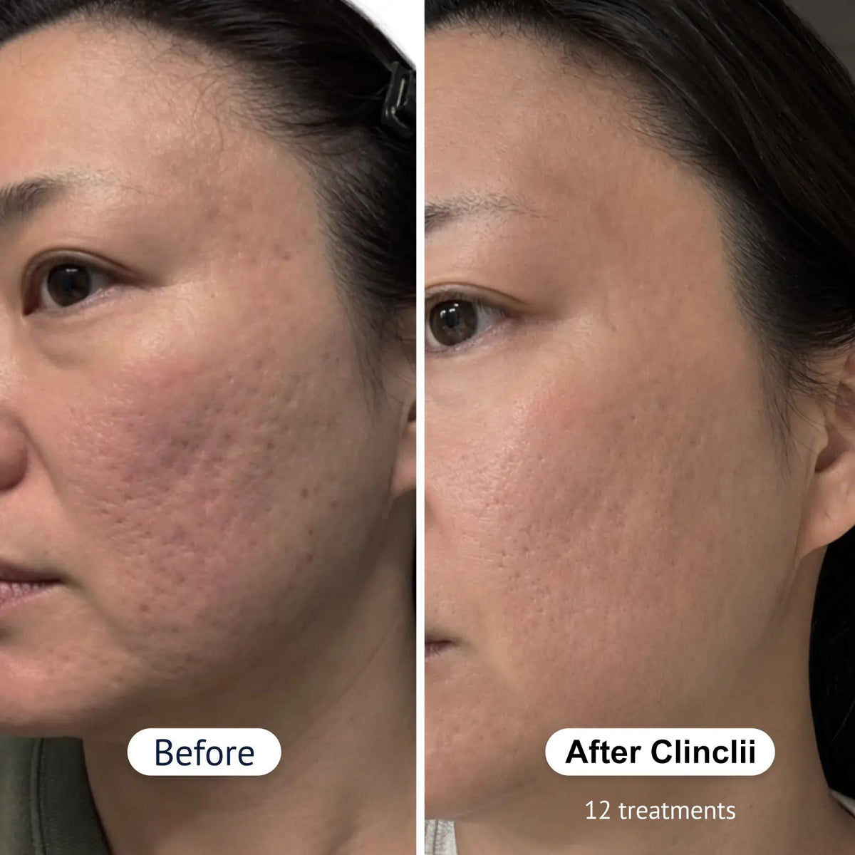 PDRN Micro-Penetration Care System | Revitalize Your Skin's Natural Radiance