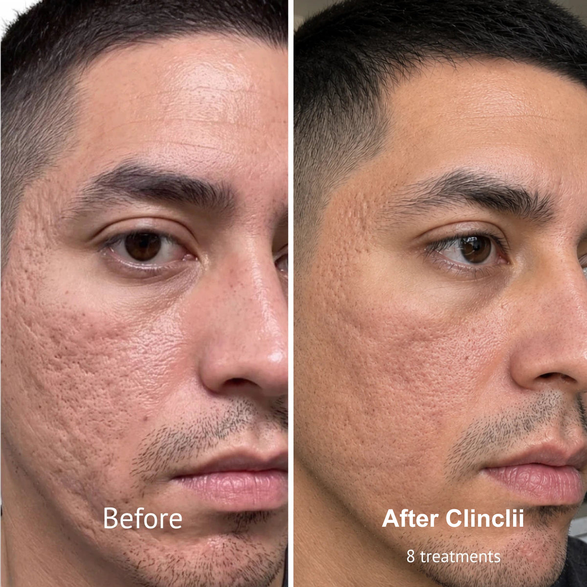 PDRN Micro-Penetration Care System | Revitalize Your Skin's Natural Radiance