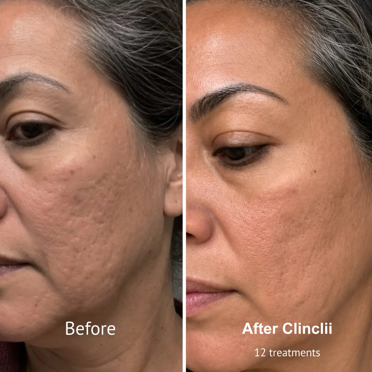 PDRN Micro-Penetration Care System | Revitalize Your Skin's Natural Radiance